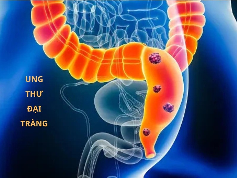 Ung thư đai tràng có thể di căn ra các nơi khác.